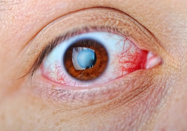 Optic Atrophy