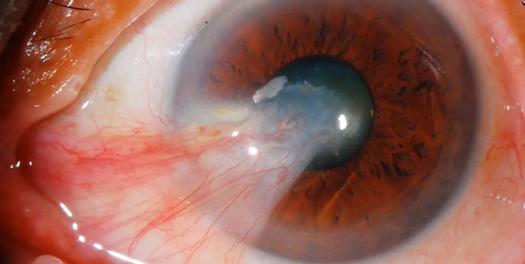 Uveitis
